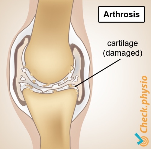 osteoarthritis anatomy degeneration