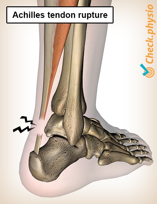 lower leg achilles tendon rupture