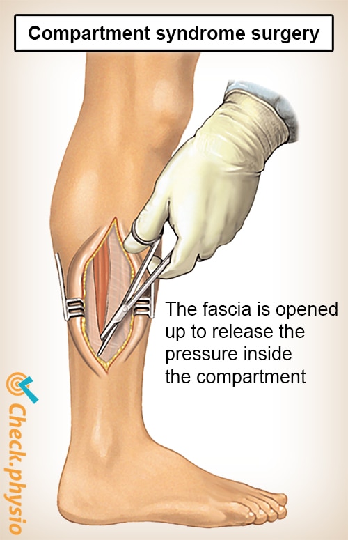 lower leg compartment syndrome surgery