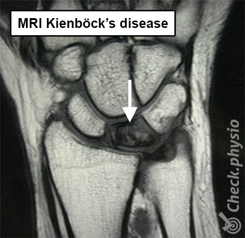 wrist Kienbocks disease mri lunate bone