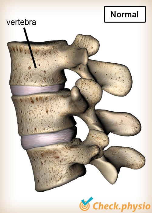 back Bechterew vertebrae normal