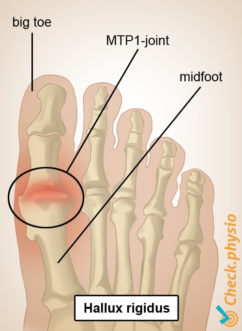 foot hallux rigidus big toe MTP 1 joint