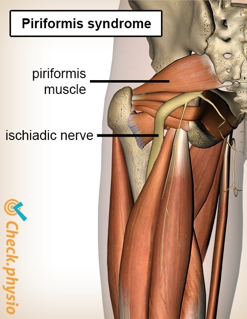 buttock butt piriformis syndrome anatomy