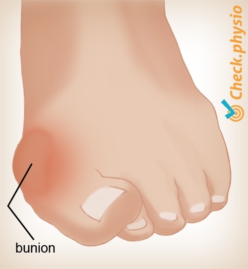 foot hallux valgus bunion