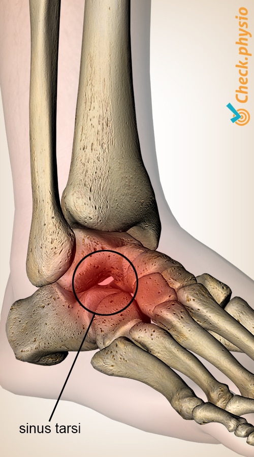 foot sinus tarsi syndrome talus calcaneus