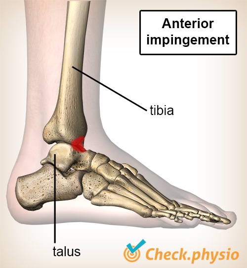 Anterior Ankle Impingement Physio Check