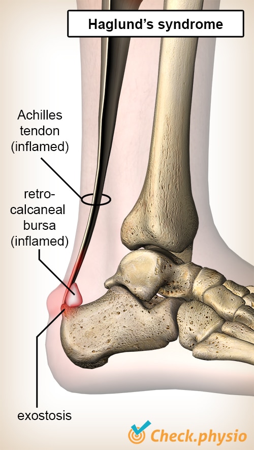 Haglund's exostosis Physio Check