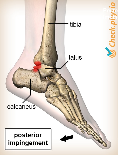 ankle posterior impingement plantar flexion