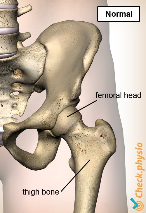 hip epiphysiolysis capitis femoris normal