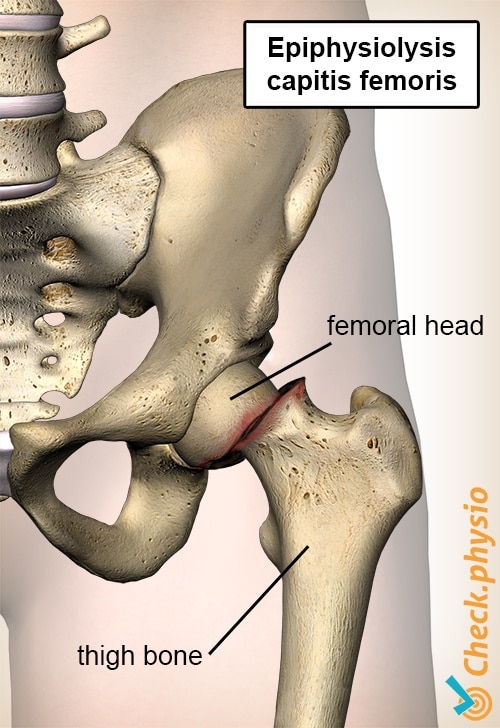 hip epiphysiolysis capitis femoris