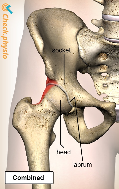 hip femoroacetabular impingement FAI mixed combined