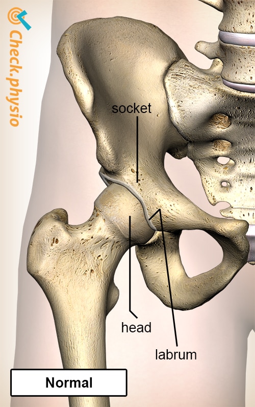 hip femoroacetabular impingement FAI normal