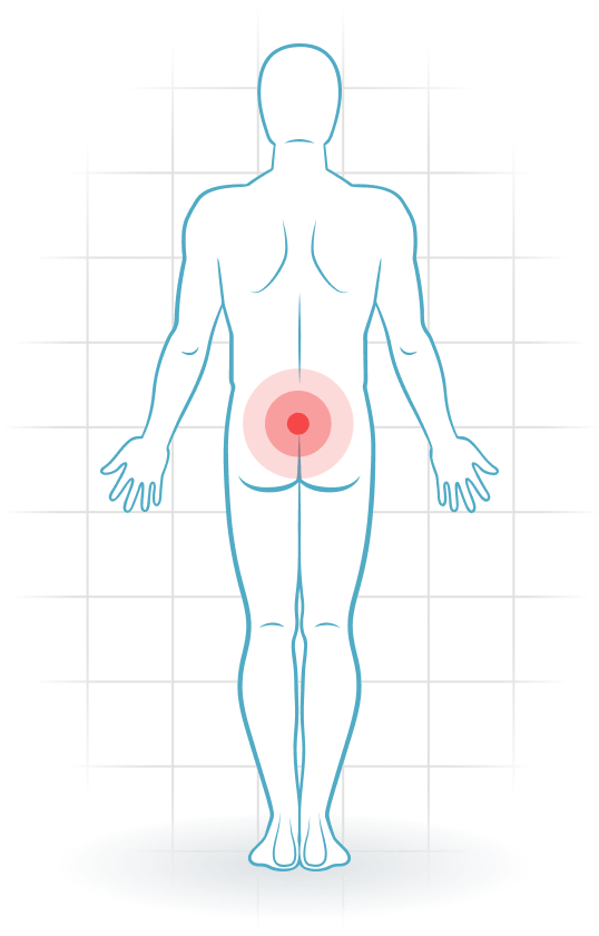 pijnlocatie Lumbar facet syndrome