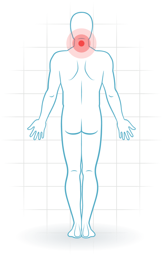 pijnlocatie Whiplash associated disorders