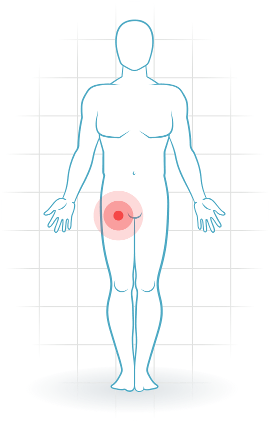 pijnlocatie Osteoarthrosis of the hip