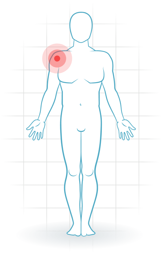 pijnlocatie Subscapularis tendinopathy