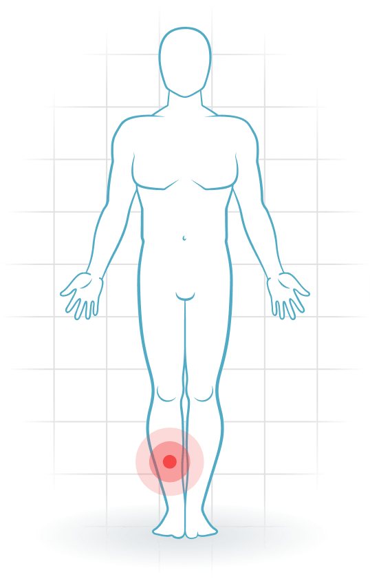 pijnlocatie Medial tibial stress syndrome