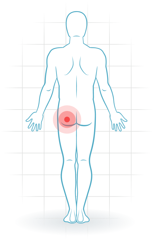 pijnlocatie Piriformis syndrome