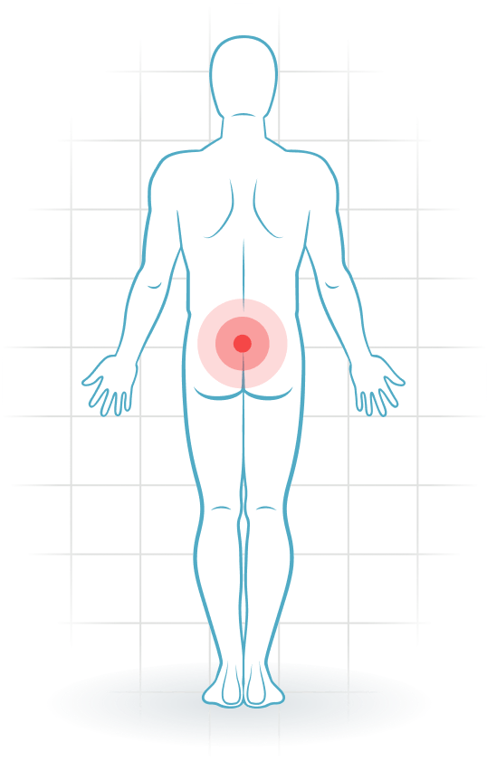 pijnlocatie Pelvic instability