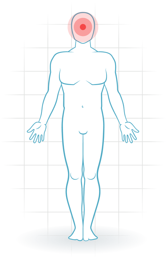 pijnlocatie Cervicogenic headache