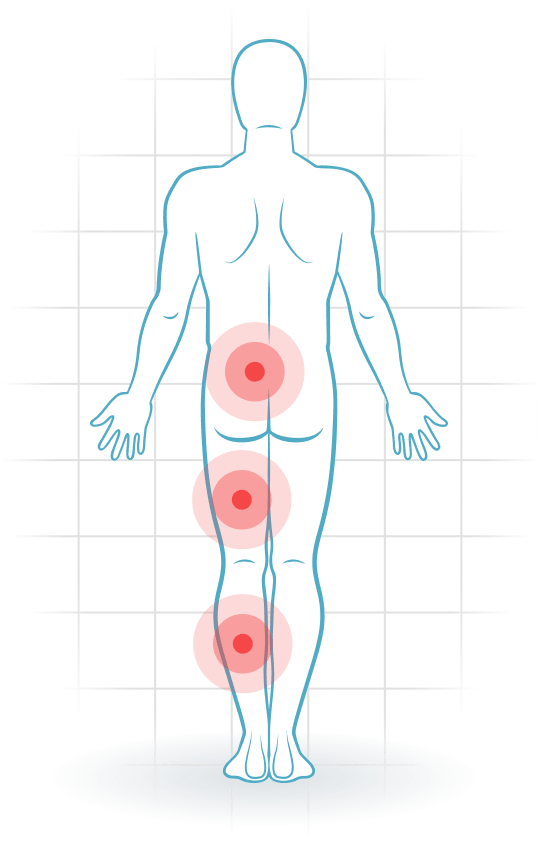 pijnlocatie Lumbar spinal stenosis