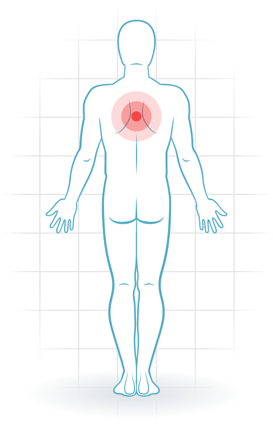 pijnlocatie Muscle injury of the upper back