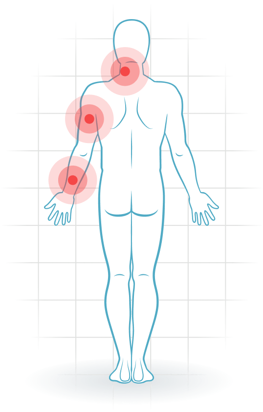 pijnlocatie Cervical radiculopathy