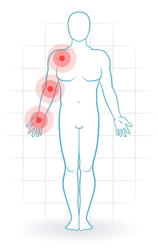 pijnlocatie Thoracic outlet syndrome